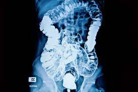 Barium Swallow What To Expect And Side Effects