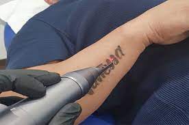 Cronin is a dermatologist in melbourne, fl. Laser Tattoo Removal Hair Removal Age Spot Removal More Brevard Fl