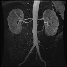 The renal arteries are paired arteries that supply the kidneys with blood. Accessory Renal Artery Radiology Reference Article Radiopaedia Org
