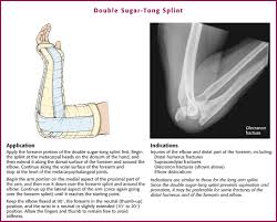 Image result for Long Arm Splint