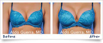 Breast Augmentation Photos Scottsdale And Phoenix Arizona