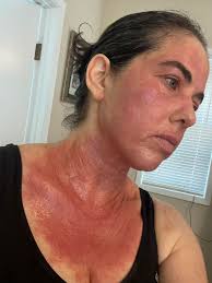 I've had this flare all summer. Was hospitalized for 3 days a month ago,  because it was so infected. I'm almost done tapering off prednisone. It's  so weird how it's just where