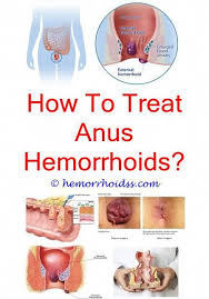 Essential Oils For Animals In 2020 Getting Rid Of Hemorrhoids Hemorrhoid Remedies Bleeding Hemorrhoids