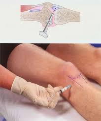 Image result for Prepatellar Bursa Injection