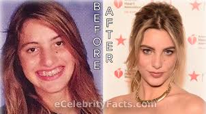 Lele Pons Before And After Plastic Surgery Plastic Surgery Face Surgery Plastic Surgery Photos