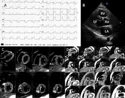 The possible pathophysiology and proposed guideline. Acute Viral Myocarditis Due To Influenza H3n2 Infection Resembling An Acute Coronary Syndrome A Case Report