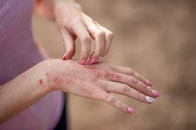 Image result for contact dermatitis