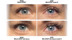 Increasing your usage will not give you bigger, longer, or fuller eyelashes. Latisse Treatment Aesthetica Skin Health Center