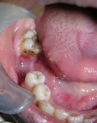 Image result for granuloma gum disease