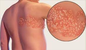Fuoco Di Sant Antonio Sintomi E Cure Per Contrastare Il Virus Herpes Zoster