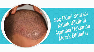 Sac Ekimi Sonrasi Kabuk Dokme Asamasini Merak Edenler Youtube