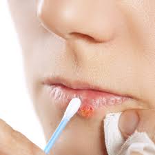 Cold Sore Remedies: How to Treat and Prevent Cold Sores on Your Lips |  Allure