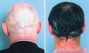 Early studies on mice suggest that emu oil can promote new hair follicles. Essential Oils For Hair Loss Cedarwood Lavender Rosemary And Thyme Allaboutemu