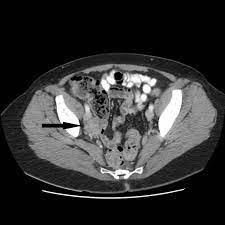 Not to be confused with endometrial cancer, endometriosis has different symptoms and treatments, including surgery. B 63 Year Old Postmenopausal Female With Ureteral Endometriosis Axial Download Scientific Diagram