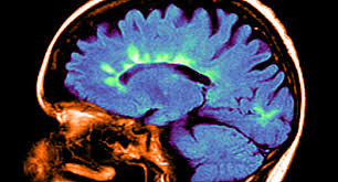 This process results in the de… Signs Of Multiple Sclerosis Relapse