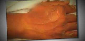 Woman Charged In Alleged Fake Mcdonald S Coffee Burn Case Abc News