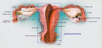 I had a hysterectomy when i was 17 years old. What Happens To Your Body After A Hysterectomy What To Expect Cigc