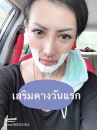 ประสบการณ์เสริมคางครั้งแรก: สิ่งที่ควรรู้และข้อกำหนด