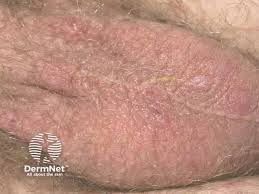 Image result for scabies on genitals