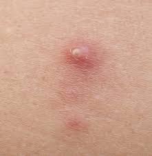 Dermatologist offers tips on how to protect face. 5 Common Skin Cancer Misconceptions