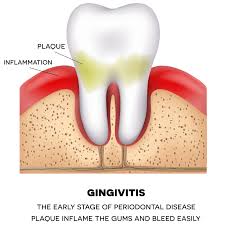 Gingivitis is caused by the buildup of plaque, an invisible sticky film of bacteria that forms on your teeth after eating sugars and starches. Gum Disease Therapy Julie Stante Dds