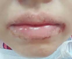 Check spelling or type a new query. Era Corner Cara Elak Bibir Kering