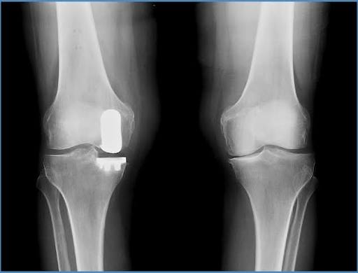 Mako Partial Knee — image 3