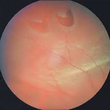 Jun 12, 2021 · parrina et al from government hospital, chandigarh reported an interesting case of rhegmatogenous retinal detachment with giant retinal tear in a child with marfanoid features. Area Of Peripheral Retina With 2 Horseshoe Shaped Retinal Tears In An Download Scientific Diagram