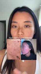 Mi viaje hacia una piel sin acné