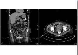 A Rare Complication Of Intravesical Early Instillation Of Mitomycin C After Turbt Sciencedirect