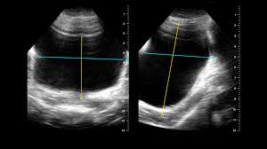 Bile membantu anda mencerna lemak. Pundi Kencing Pasca Kekosongan Sifsof