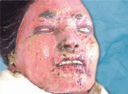 Full thickness burns with eschar (including leathery eschar); Jaypeedigital Ebook Reader