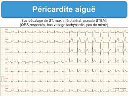 The pain is typically less severe when sitting up and more severe when lying down or breathing deeply. Pericardite Aigue 2 Atypique E Cardiogram