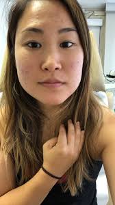 Peanuts wheat germ and eggs should be included for prevention of anemia. My Hormonal Acne Journey Healing Managing Acne Living Minnaly