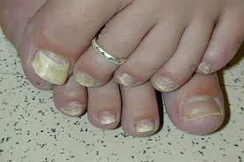 Immediately get a file file through what's shinny. Onychomycosis