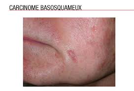 Orientation diagnostic pour un traitement selon la cause, pruritus of the skin: Les Cancers Cutanes Non Melanomateux Medscape