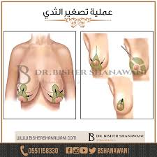 راحة تكبير الثدي هي إحدى الجراحات التجميلية الأكثر شيوعا عملية تصغير الثدي مع د بشر الشنواني شد الصدر يمكن للثدي الكبير جدا Plastic Surgery Surgery Vegetables