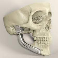 3d Printing Healthcare Market Is Expected To Grow By 18 Annually Until 2020 Medical Technology Prints 3d Printed Metal