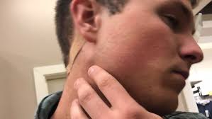 Parkinson's Disease and Exercise