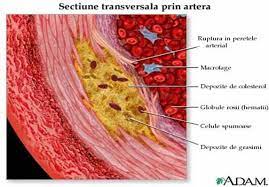 La placa de ateroma es una estructura bien definida desde el punto de vista de la anatomía patológica, sin embargo ¿qué es una placa de ateroma vista por ultrasonido? Afectiuni Cardiovasculare 1 Arterioscleroza Arterioscleroza Este Un Termen General Care Descrie IntÄrirea Si Pierderea De Elasticitate A Arterelor Arterioscleroza Este O BoalÄ CronicÄ Cu Caracter Distrofic Producand Ingrosarea ProgresivÄ A PereÅ£ilor