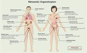 Cancer that has started in one place can spread to and invade other parts of the body. Molecular Principles Of Metastasis A Hallmark Of Cancer Revisited Signal Transduction And Targeted Therapy