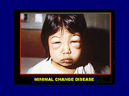 Minimal change disease