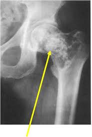 Image result for Chondrosarcoma