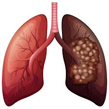 However, each case of lung cancer is unique. What Is Early Stage Lung Cancer Lung Cancer Pintas Mullins Law Firm
