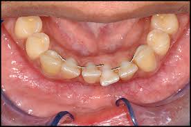 Check spelling or type a new query. Inadvertent Tooth Movement With Fixed Lingual Retainers American Journal Of Orthodontics And Dentofacial Orthopedics