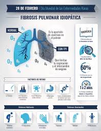 Encuentra los mejores especialistas en fibrosis pulmonar idiopática en españa y resuelve tus dudas preguntando a los expertos. Por Que Esperar La Fibrosis Pulmonar Idiopatica No Espera