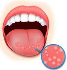Eine verletzung der zunge kann dazu führen, dass sie holprig aussieht oder sich holprig anfühlt. Mundfaule Stomatitis Bei Babys Kindern