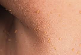 2020 popular 1 trends in beauty & health, hair clips & pins, combs, braiders with hair bump and 1. Pictures Of Bumps On Skin Cysts Skin Tags Lumps And More