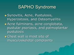 Image result for What Is A Synovitis Acne Pustulosis Hyperostosis Osteomyelitis Syndrome?