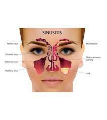 What Can I Take For Sinus Infection While Breastfeeding